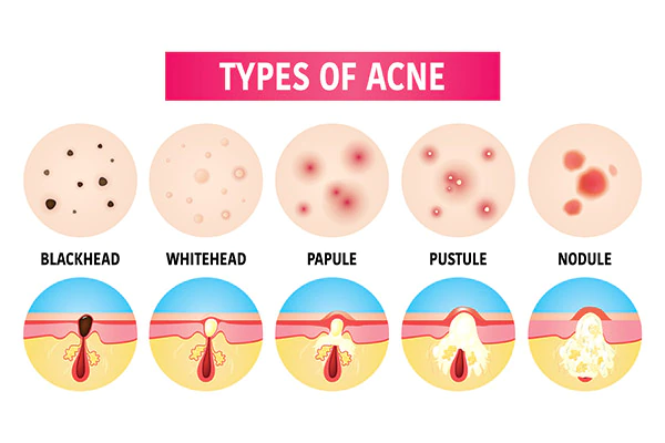 What causes acne? and how to treat it? - Richard Coward