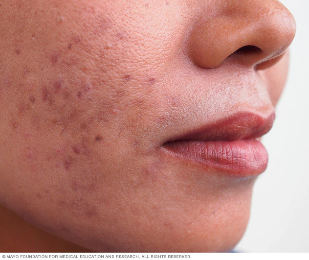 What causes acne? and how to treat it?